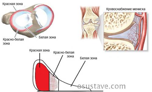 Как лечат мениск в колене. Что такое мениск коленного сустава, возможные повреждения, их причины и лечение