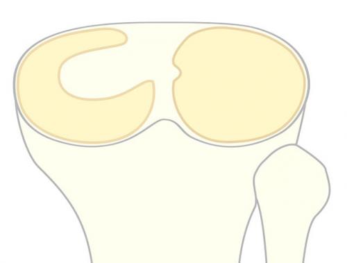Как лечат мениск в колене. Что такое мениск коленного сустава, возможные повреждения, их причины и лечение