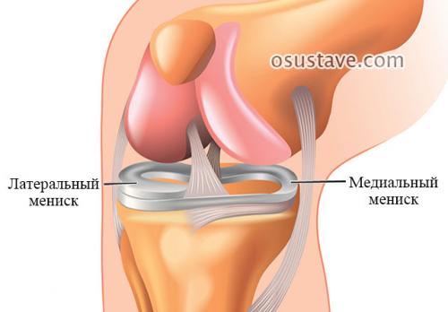 Разрыв заднего рога латерального мениска коленного сустава лечение. Виды повреждений мениска коленного сустава: их обзор, степени, симптомы и лечение