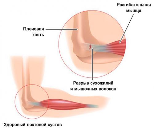 Ушиб локтевого сустава, как долго болит. Обзор ушиба локтевого сустава: виды, степени, симптомы и лечение