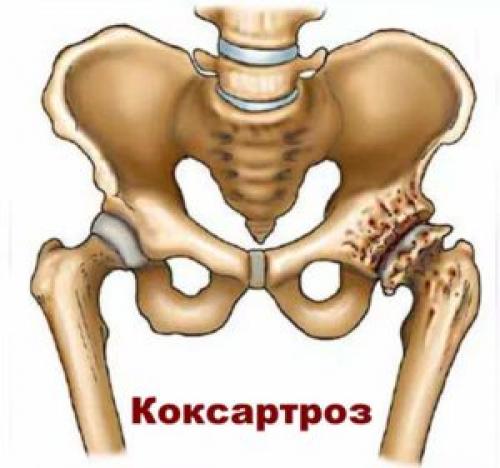 Где находится головка тазобедренного сустава. Строение тазобедренного сустава