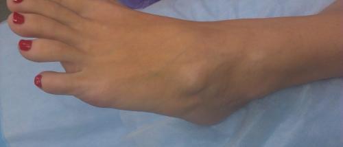 Гигрома операция. Хирургическое лечение гигромы