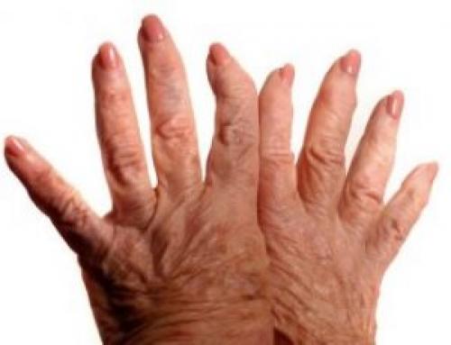 Межфаланговый сустав функции. Межфаланговый сустав