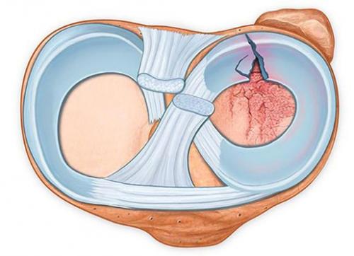 Как лечат мениск в колене. Что такое мениск коленного сустава, возможные повреждения, их причины и лечение