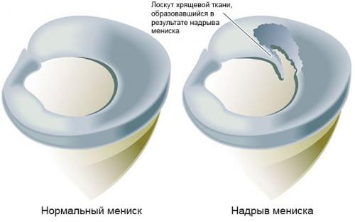 Как лечат мениск в колене. Что такое мениск коленного сустава, возможные повреждения, их причины и лечение