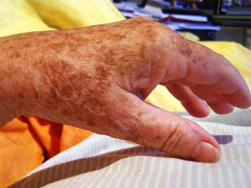 На пальцах рук появились маленькие коричневые точки. Почему на руках появляются коричневые пигментные пятна и как от них избавиться