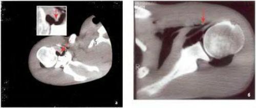 Синдром Хилл-Сакса. Перелом шейки плеча реабилитация — клиника, прогнозы и исходы травмы 10