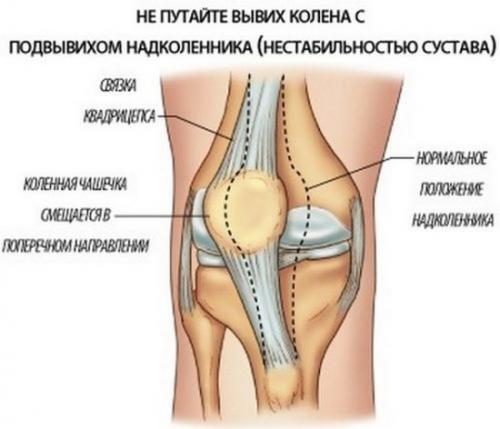 Коленный сустав. Эффективные средства от боли в коленном суставе