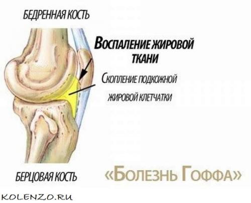 Коленный сустав. Эффективные средства от боли в коленном суставе