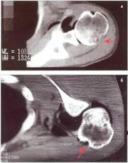 Импрессионный перелом головки бедренной кости. Перелом Хилл-Сакса плечевой кости кт. Повреждение Хилл-Сакса плечевого сустава кт.