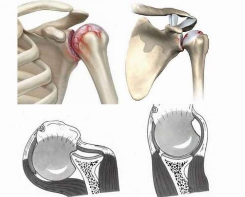 Перелом Хилл-Сакса мрт. Что такое повреждение Хилл-Сакса