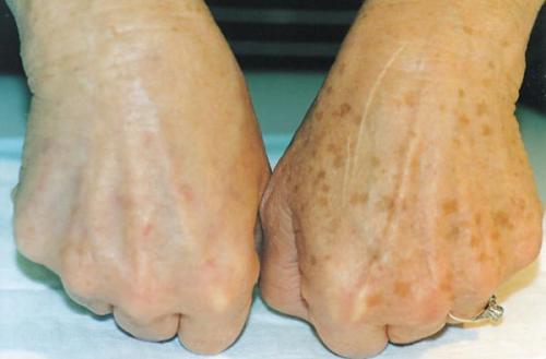 На пальцах рук появились маленькие коричневые точки. Почему на руках появляются коричневые пигментные пятна и как от них избавиться