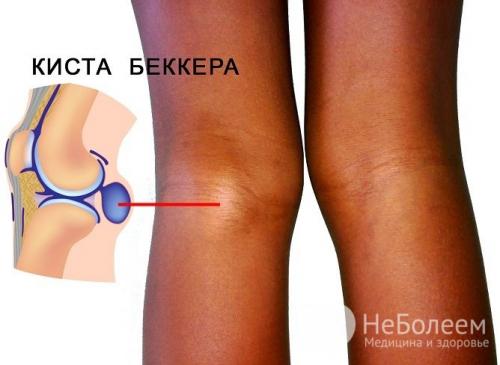 Киста бехтерева википедия. Киста Бейкера