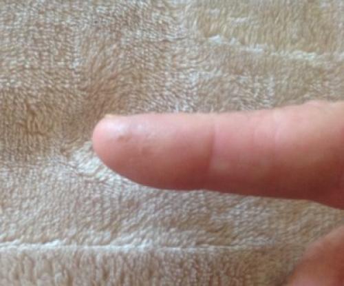 На пальцах рук появились наросты, как мозоли, как лечить. Причины появления мозоли от ручки