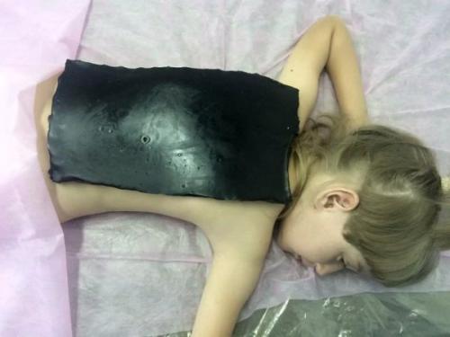 Парафин на спину ребенку. Область и правила применения парафино- и озокеритотерапии в детской практике