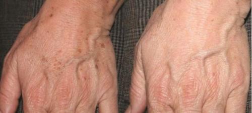 На пальцах рук появились маленькие коричневые точки. Почему на руках появляются коричневые пигментные пятна и как от них избавиться