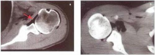 Перелом хилла сакса. Непростой перелом головки плеча испортит не только отпуск 06