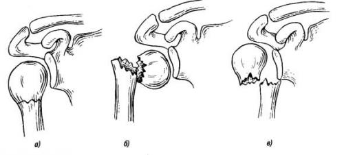 Боль в плече в состоянии покоя. Ортопедические болезни при боли в плече