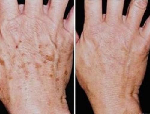 На пальцах рук появились маленькие коричневые точки. Почему на руках появляются коричневые пигментные пятна и как от них избавиться