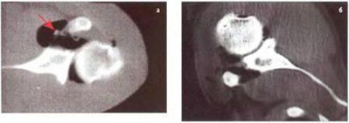 Синдром Хилл-Сакса. Перелом шейки плеча реабилитация — клиника, прогнозы и исходы травмы 11