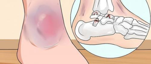 Как определить вывих плеча или растяжение. Чем отличается вывих от растяжения?