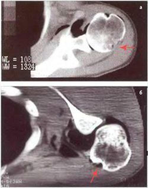 Синдром Хилл-Сакса. Перелом шейки плеча реабилитация — клиника, прогнозы и исходы травмы 13