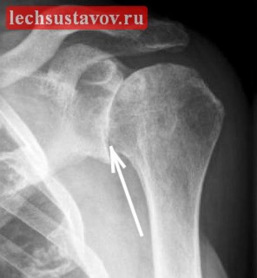 Остеоартроз плечевого сустава: признаки, симптомы, степени, лечение