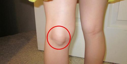 Киста бехтерева под коленом к какому врачу обратиться. Обзор кисты Бейкера коленного сустава: причины, симптомы и лечение