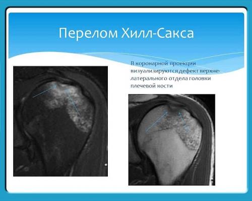 Дефект Хилл-Сакса лечение. Классификация