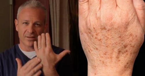 На пальцах рук появились маленькие коричневые точки. Почему на руках появляются коричневые пигментные пятна и как от них избавиться