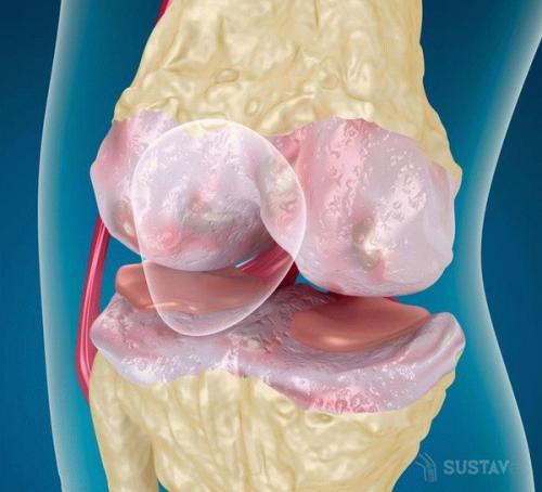Киста бехтерева в коленном суставе лечение. Киста Бейкера коленного сустава, как ее можно вылечить 03 Киста бехтерева в коленном суставе лечение. Киста Бейкера коленного сустава, как ее можно вылечить 03