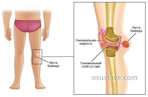Киста бехтерева под коленом к какому врачу обратиться. Обзор кисты Бейкера коленного сустава: причины, симптомы и лечение