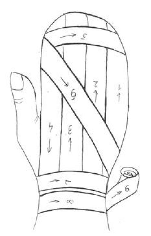 Повязка варежка. Алгоритм наложения повязки «варежка» на все пальцы кисти.