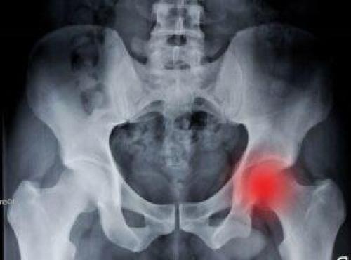 Коксартроз тазобедренного сустава симптомы и лечение. Как лечить коксартроз на любой стадии