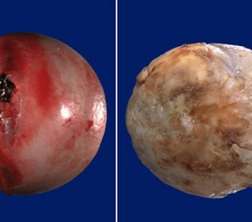 Коксартроз тазобедренного сустава 3 степени: лечение без операции