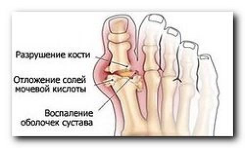 Шишка на большом пальце ноги сверху. Шишка на большом пальце ноги — причины и симптомы, фото
