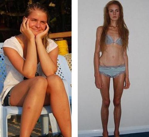 Как вызвать рвоту для похудения. Рвота для похудения. Как вызвать рвоту для похудения