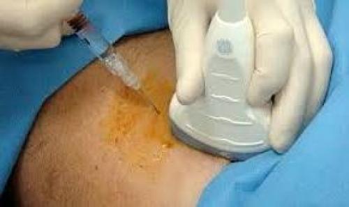 Коксартроз тазобедренного сустава симптомы и лечение. Как лечить коксартроз на любой стадии