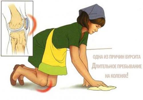 Лечение народными средствами бурсит колена. Лечение бурсита коленного сустава в домашних условиях