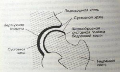 Коксартроз тазобедренного сустава симптомы и лечение. Как лечить коксартроз на любой стадии