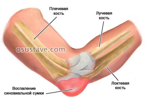 Ударила локоть по нерву. Обзор ушиба локтевого сустава: виды, степени, симптомы и лечение