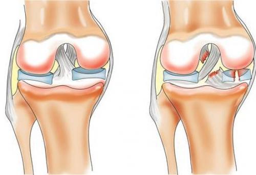 Болит колено можно ли ездить на велосипеде. Из-за чего болят коленные суставы