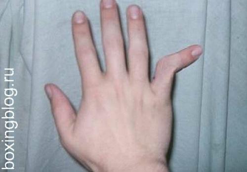 Выбит большой палец на руке симптомы. Что делать, если выбит сустав на пальце руки