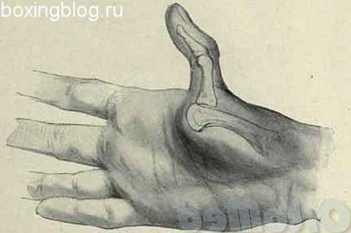 Выбил большой палец на руке бокс. Что делать, если выбит сустав на пальце руки
