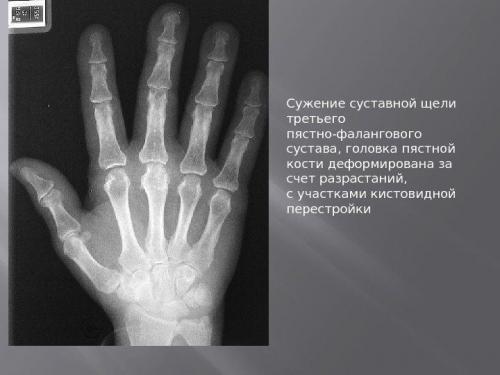 Травматический артроз кисти рук и его лечение. Правильное лечение деформирующего артроза кистей рук