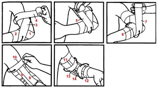 Повязка черепашья сходящаяся на коленный сустав. Техника наложения