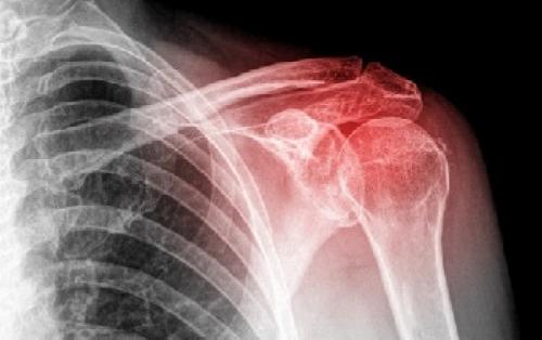 Хрустят плечевые суставы, что делать. От чего появляется? 05 Хрустят плечевые суставы, что делать. От чего появляется? 05