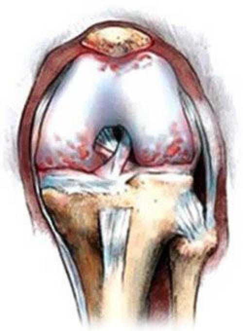Стерся хрящ в коленном суставе лечение. Как восстановить хрящевую ткань сустава?