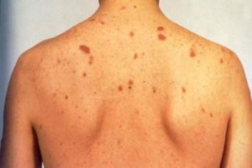 Как повысить тромбоциты при беременности. Роды при тромбоцитопении