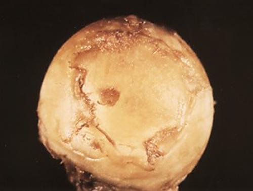 Асептический некроз таранной кости. Лечение некроза таранной кости голеностопного сустава в Москве 02 Асептический некроз таранной кости. Лечение некроза таранной кости голеностопного сустава в Москве 02